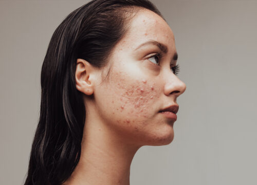 Photo of a woman with acne and acne scars