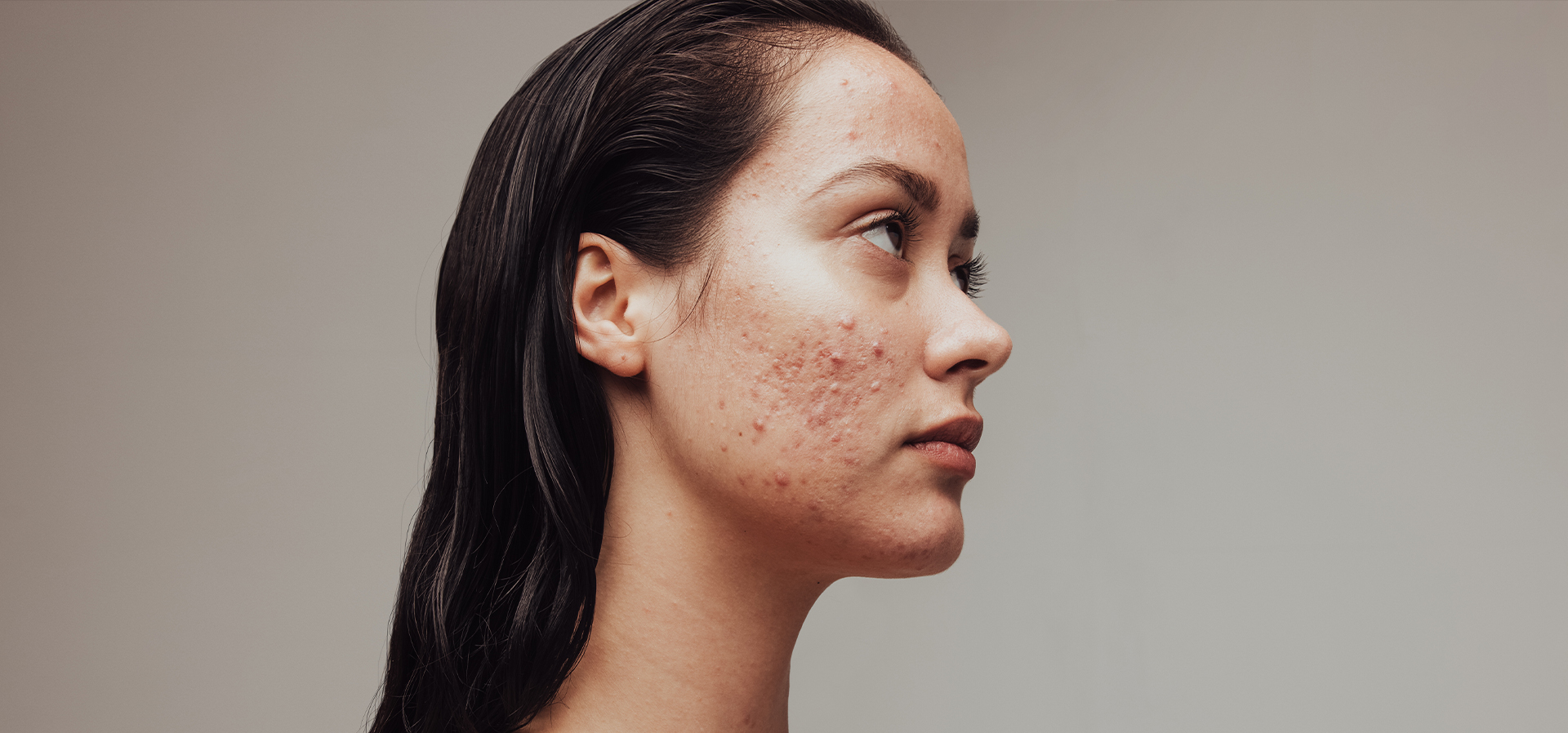 Acne + Acne Scarring