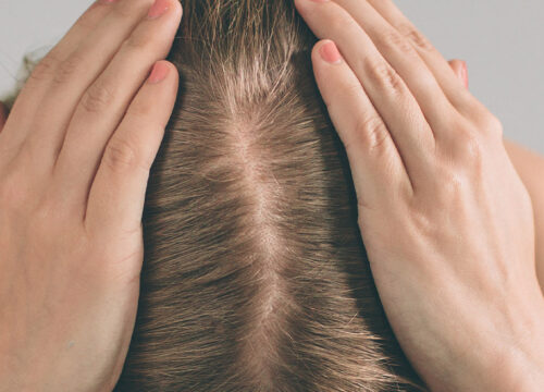 Photo of a woman's hair loss