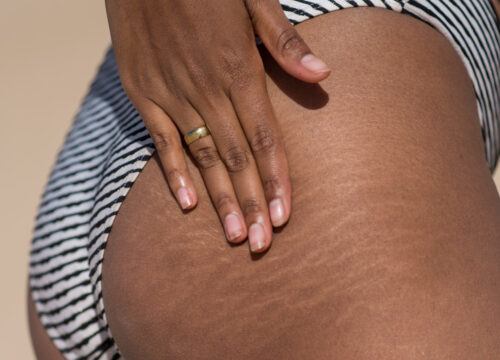 Photo of stretch marks on a woman's buttock